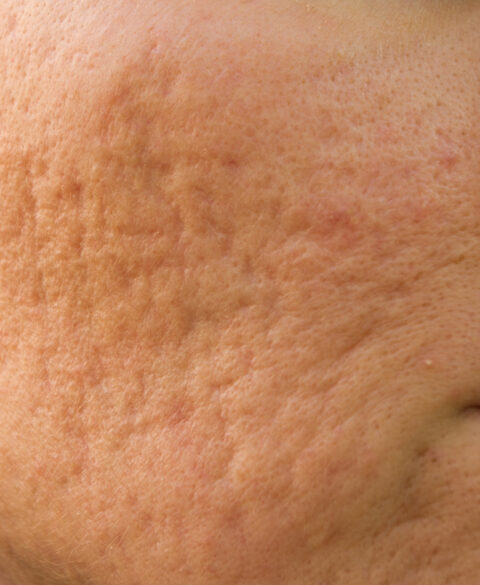 acne scars remedy