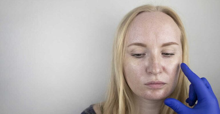 Oily and problem skin. Portrait of a blonde girl with acne, oily skin and pigmentation