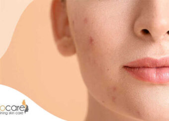 Why do adults suffer from acne?