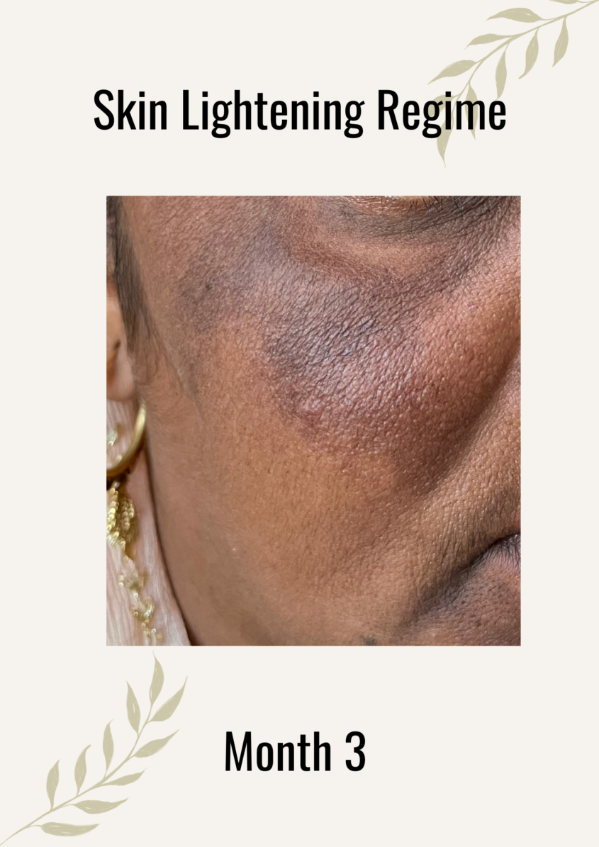 skin lightening regime month 3