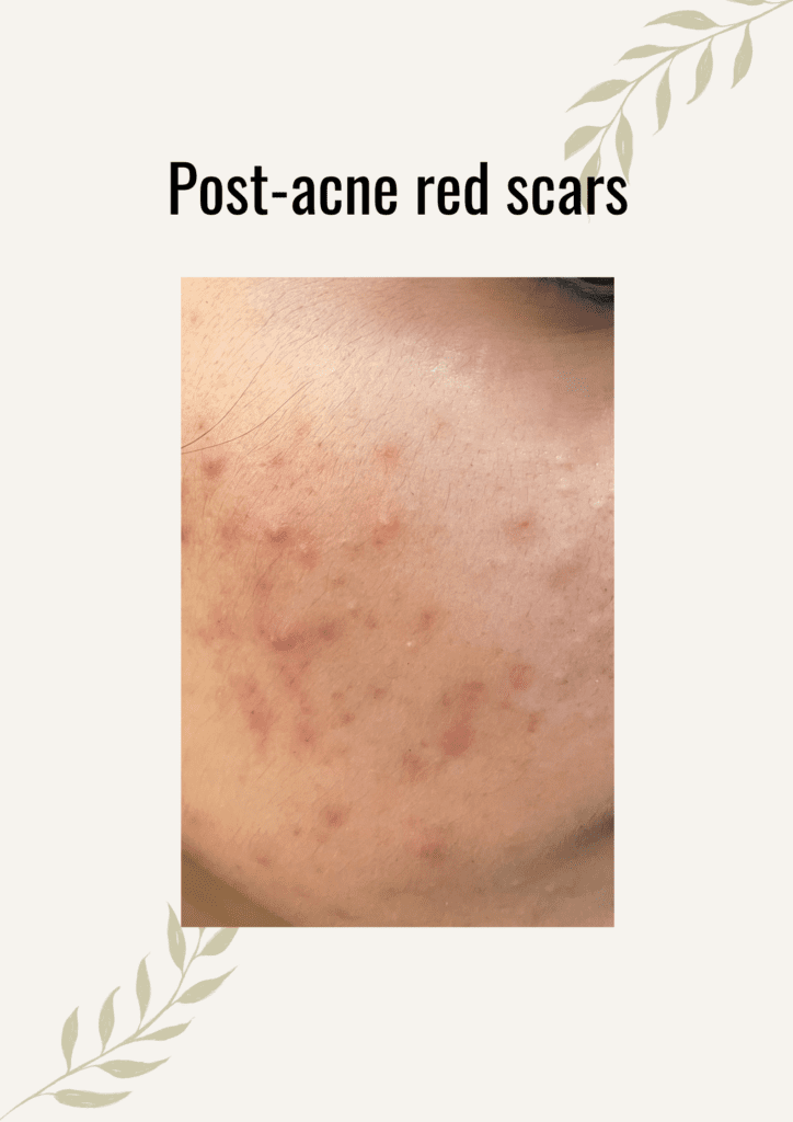 red-scar-treatment