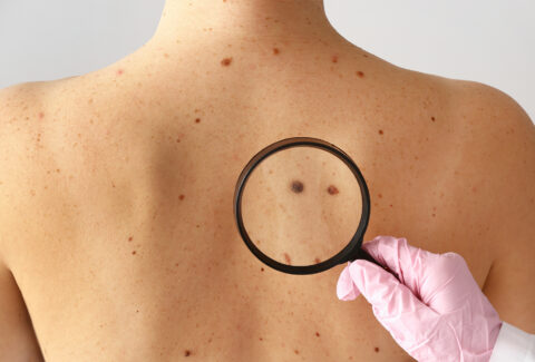 skin-cancer-screening
